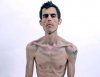 anorexia_251010.jpeg