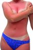 xnatural-cure-for-sunburn-21391420.jpg